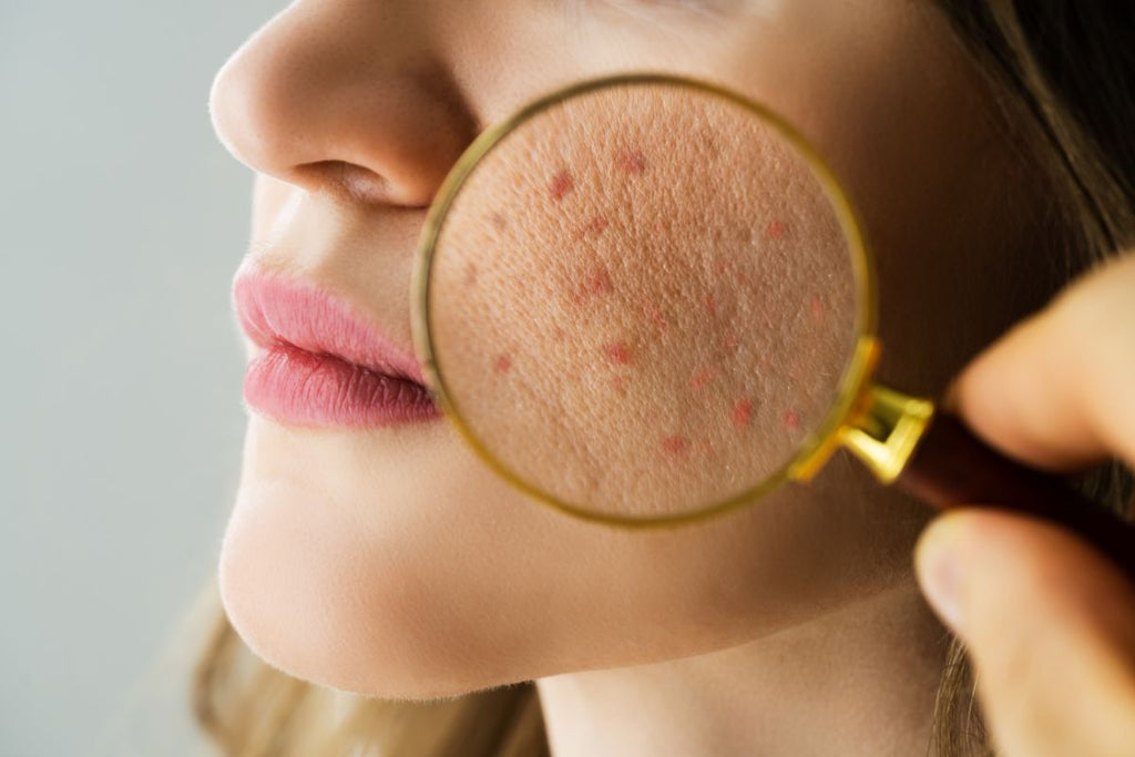 Acne vulgaris