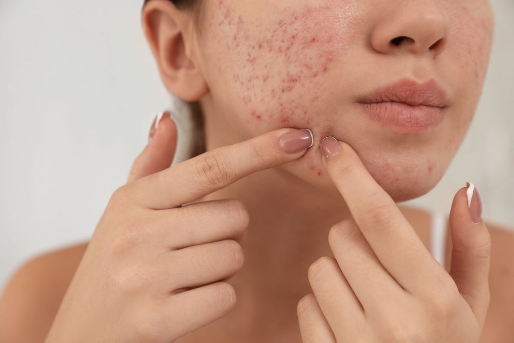 Woman-squeezing fungal acne to her face