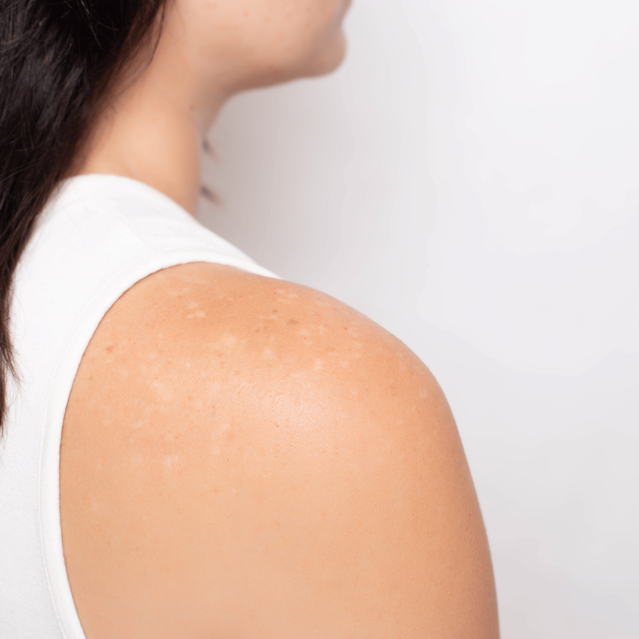 decoding-vitamin-deficiency-and-small-white-spots-on-skin-the